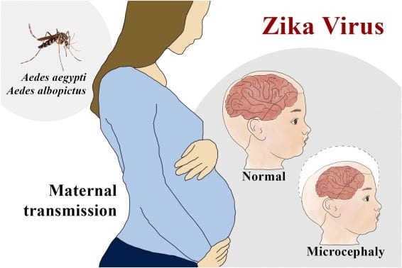 Zika Virus Cases Reported In Kerala Zika Virus Symptoms Treatment Prevention 7068